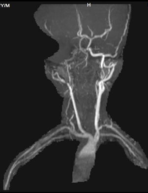 <b>Figure 4:</b> Carotid angiography shows marked luminal narrowing at the right common carotid artery bifurcation and along the entire length on external carotid artery and internal carotid artery.